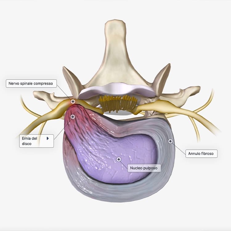 Vertebra-Ernia