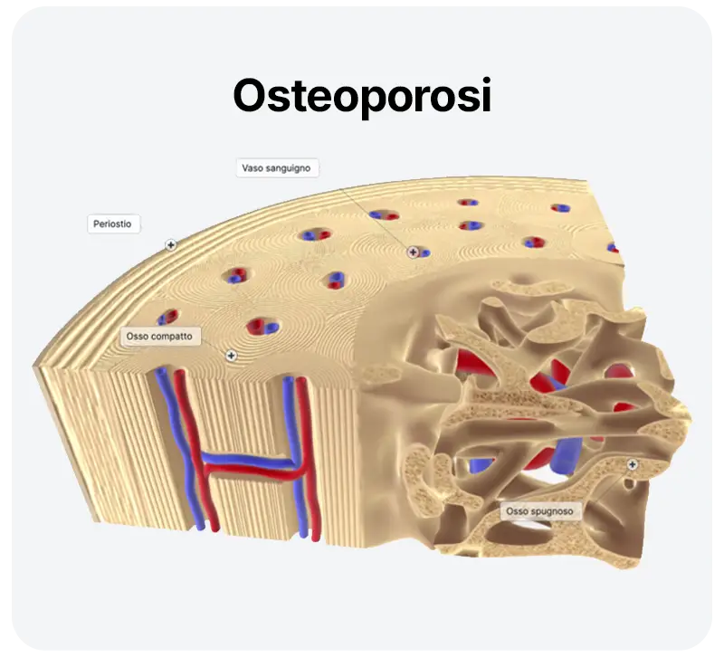 Osteoporosi nell'anziano